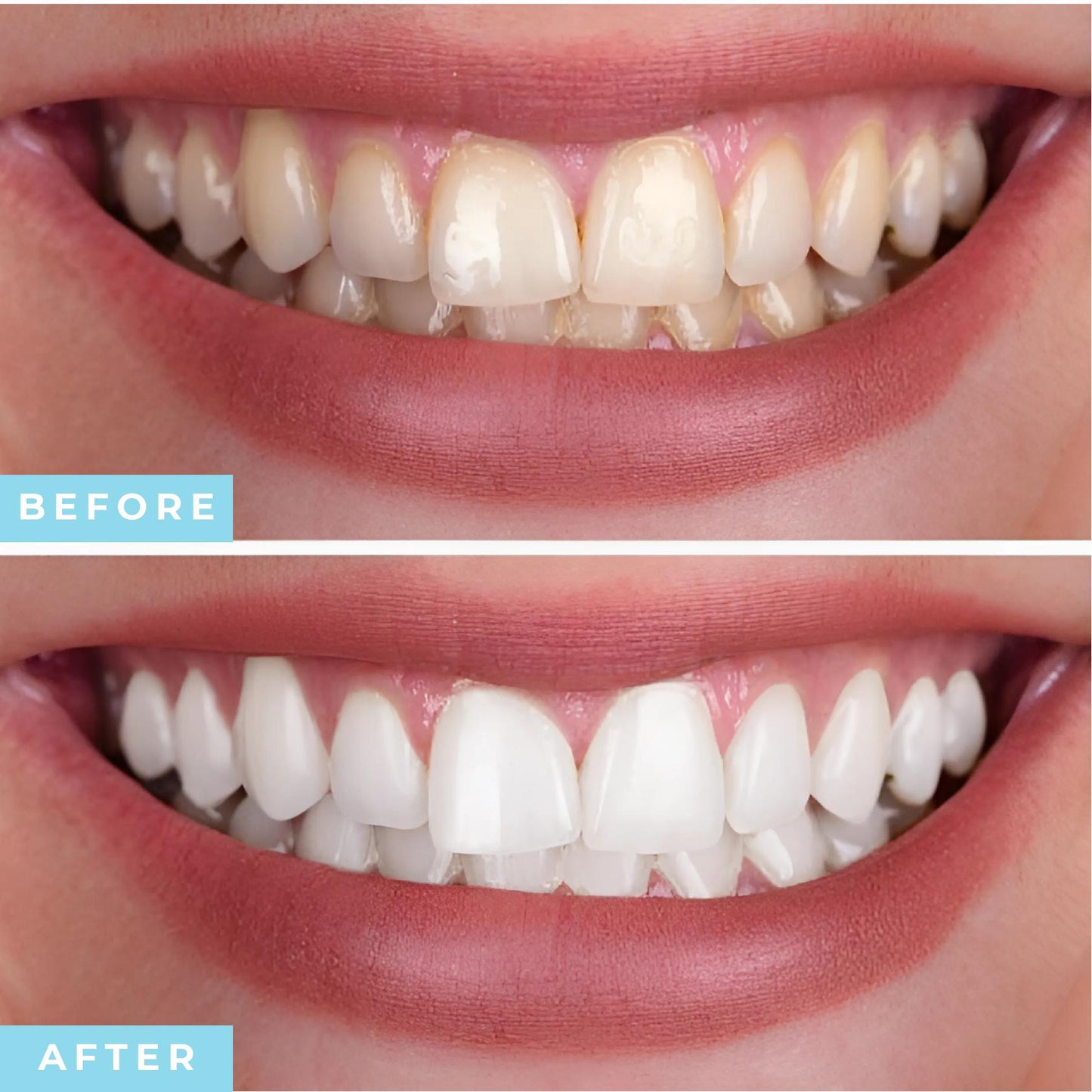 Ultrasonic Tooth Cleaner